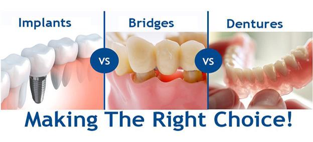 DENTAL IMPLANTS