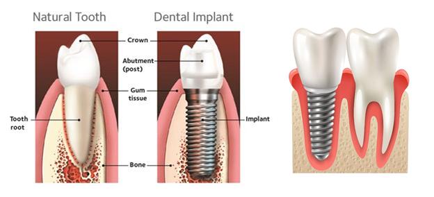 DENTAL IMPLANTS- LOST A TOOTH? NEED A FIXED NATURAL LOOKING REPLACEMENT