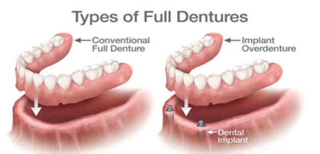 DENTURES