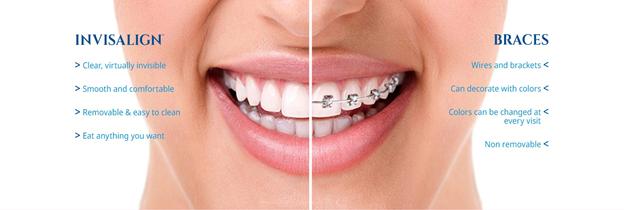 INVISIBLE ALIGNERS- NO MORE EMBARASSING BRACES