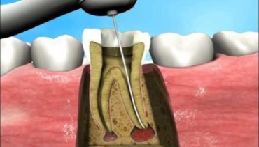 ROOT CANAL TREATMENT