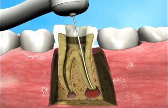 ROOT CANAL TREATMENT