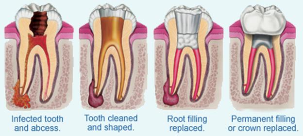 ROOT CANAL TREATMENT- WHY REMOVE TOOTH, WHEN IT CAN BE SAVED.