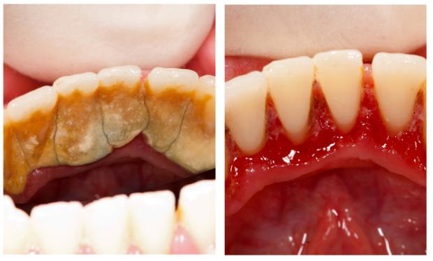 SCALING AND POLISHING