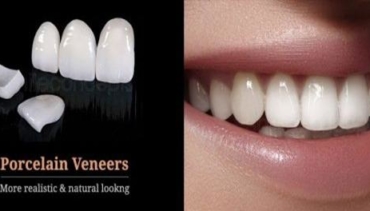 VENEERS