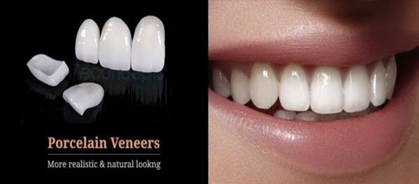 VENEERS