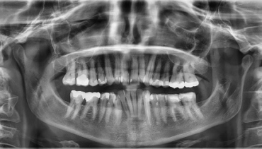 FULL MOUTH X-RAYS