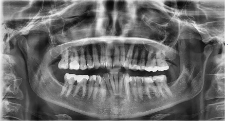 FULL MOUTH X-RAYS